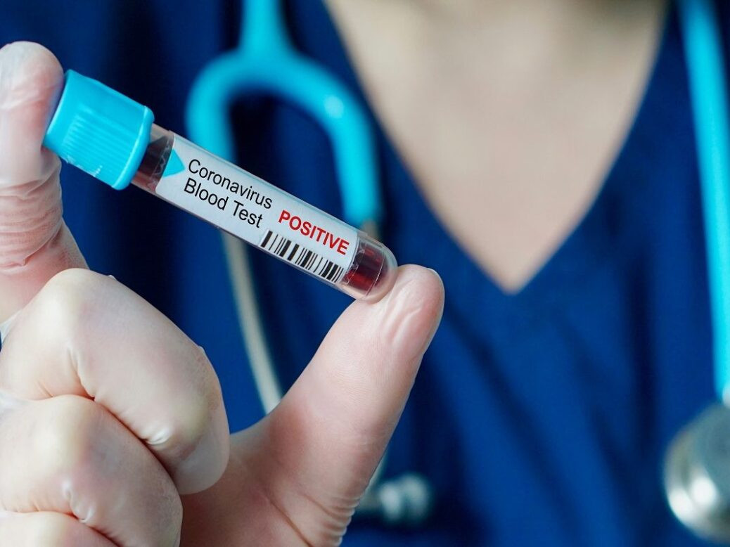 Azərbaycanda cəmi 129 koronavirus xəstəsi var